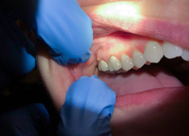 Best Emergency Dental Extractions in York, NE